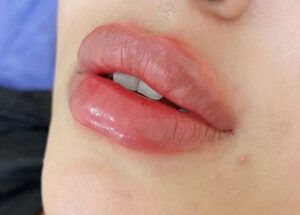 Lips Filler in VIP Clinic
