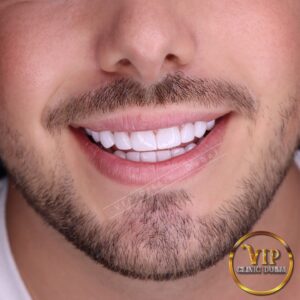 Hollywood Smile in VIP Clinic