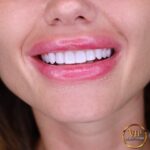 Hollywood Smile in VIP Clinic