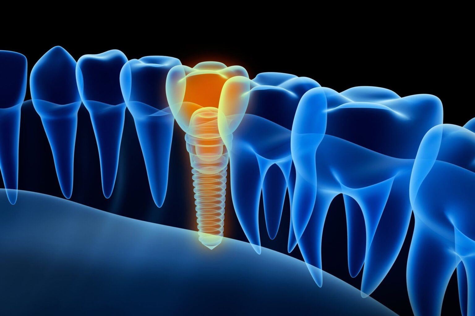 Implants: Sturdy. Easy to clean. Look and feel like real teeth.