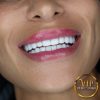 Hollywood Smile in VIP Clinic