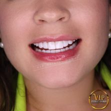 Hollywood Smile in VIP Clinic