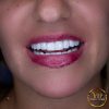 Hollywood Smile in VIP Clinic