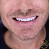 Hollywood Smile